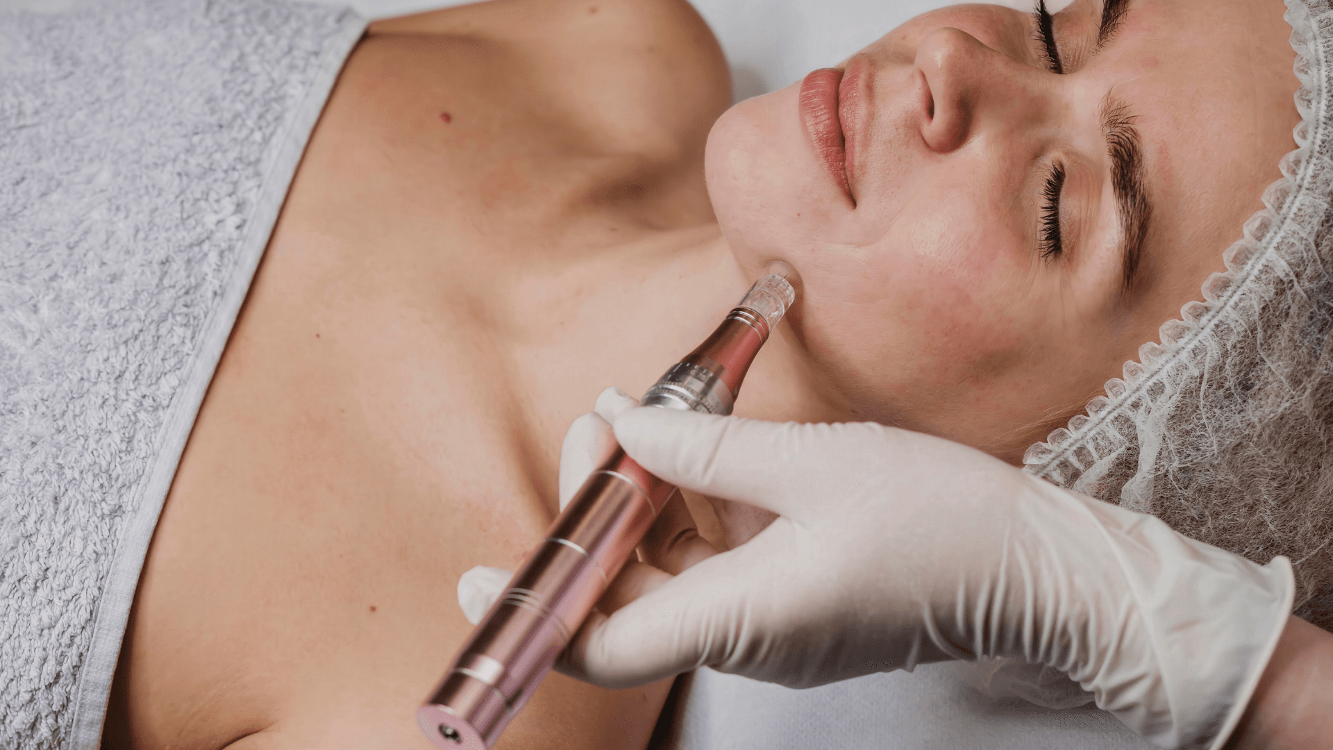 Microneedling with exosomes